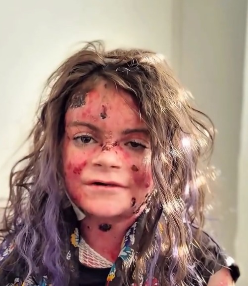 Matilde - Menina com Epidermólise Bolhosa
